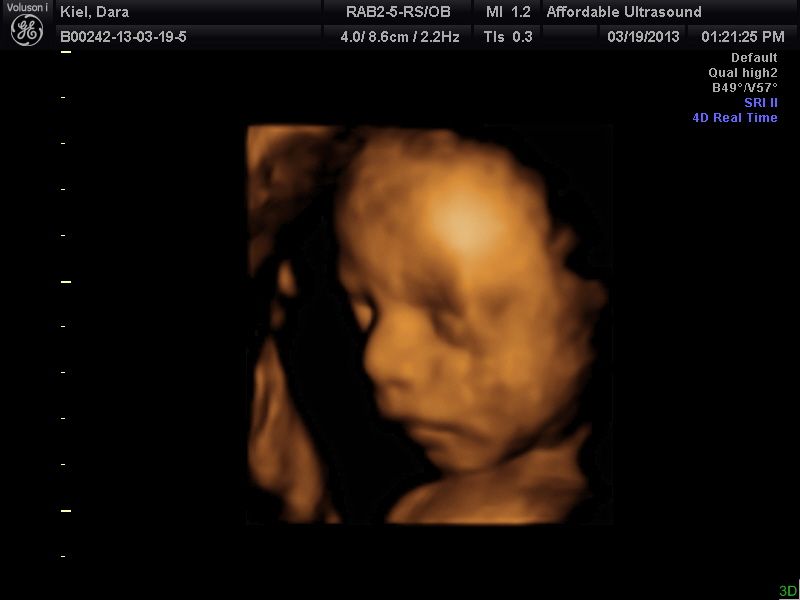 3D Ultrasound @ 27 weeks :) - BabyCenter