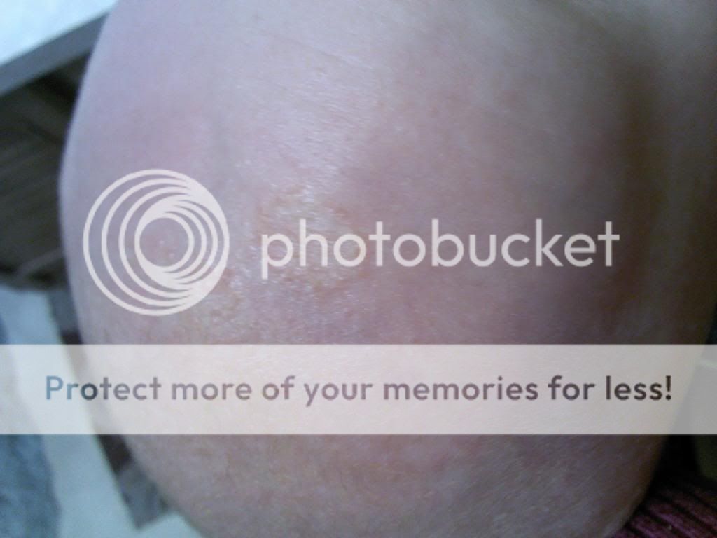 Cradle cap, exema, or (yikes!) ringworm? BabyCenter